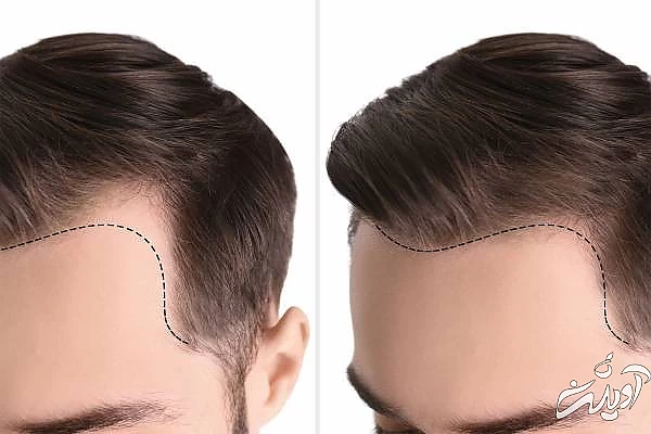 تغذیه بعد از کاشت مو کاشت مو